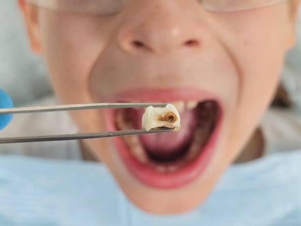 Best Emergency Root Canal Treatment in Houston, MO